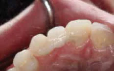 Figure 1: The patient presented with an acid-etch bridge. The teeth adjacent to the edentulous site had been minimally prepared to permit retention