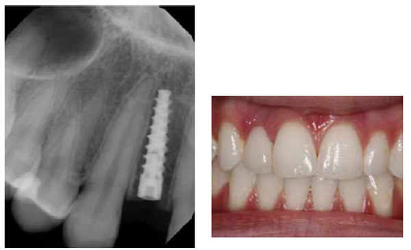 Figure 10: Despite the small space that was available, a 3.0-mm diameter tapered implant was placed with ease; Figure 11: The acid-etch bridge that the patient had been using prior to implant treatment served as a temporary during the healing period