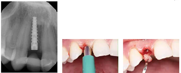 Figure 12: Full osseointegration was achieved 4 months after implant placement; Figures 13A-13B: The implant was exposed with a tissue punch