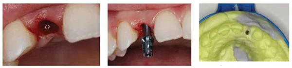 Figures 14A-14B: After removing the cover screw, a transfer coping was attached to the implant; Figure 15: A final impression was taken with Panasil vinyl polysiloxane impression material