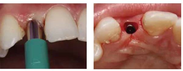Figures 16A-16B: A tissue punch was utilized prior to placement of the Inclusive Titanium Custom Abutment