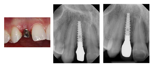 Figures 17A-17B: The custom titanium abutment was designed with margins that were slightly subgingival in order to simplify removal of excess cement; Figure 18: Radiography demonstrated complete seating of the final restoration