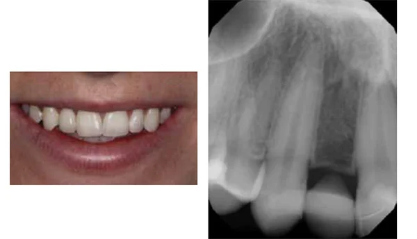 Figure 2: Though the acid-etch bridge provided good esthetics, it would come loose, causing the patient to worry about its long-term function; Figure 3: Radiography indicated that there was sufficient bone volume for the placement of an implant