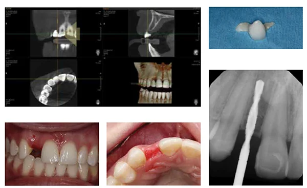 (Top Row) Figure 4: With CBCT technology, the quantity and quality of bone can be assessed digitally; Figure 5: The acid-etch bridge was removed without complication (Bottom Row) Figures 6A-6B: No interdental papillae were present due to the patient’s congenital condition; Figure 7: The depth of the osteotomy was about 13 mm