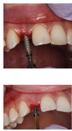 Figure 8: The implant was threaded into the undersized osteotomy; Figure 9: A cover screw was hand-tightened into the implant