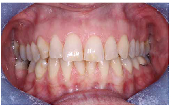 Figure 1: Preoperative photo – full retracted smile