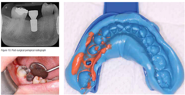 Figure 10: Post-surgical periapical radiograph; Figure 11: Postoperative photo; Figure 12: Closed tray impression