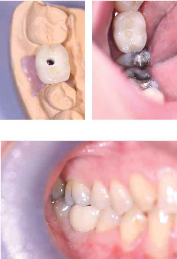Figure 16: Restoration returned from the lab (occlusal view on model); Figure 17: Screw-retained restoration in place with access filled (occlusal view); Figure 18: Screw-retained restoration in place (buccal view)