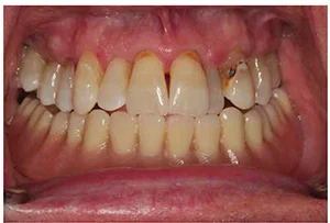Figure 1A: Pretreatment frontal view with prostheses