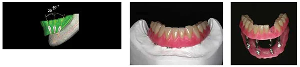 Figure 11: Diagramatic representation of the extent of divergence that is accommodated by 20º conus abutments. Note that at 40º of divergence, the bridge screw access would be lingual to the incisors (anterior) and within the first molar (posterior). Less divergence (20º-25º) is easily accommodated and readily restored with a short ( ~10 mm ) cantilever; Figures 12A-12B: 12A. Frontal view of waxed teeth try-in of the ISFD on the master cast. 12B. Frontal view of the waxed teeth try-in demonstrating screw access hole through the facial aspect of left lateral incisor