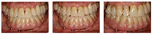 Figure 16A: Frontal view of the ISFD definitive prosthesis in CR; Figure 16B: Frontal view of the ISFD definitive prosthesis in protrusion; Figure 16C: Right lateral view of the ISFD definitive prosthesis in CR