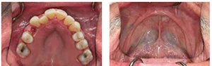 Figure 1B: Pretreatment maxillary occlusal view; Figure 1C: Pretreatment mandibular occlusal view