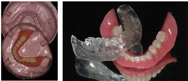 Figure 4A: Laboratory putty mold of the processed mandibular denture; Figure 4B: Mandibular denture along with its duplicate from radiopaque resin produced within the putty mold