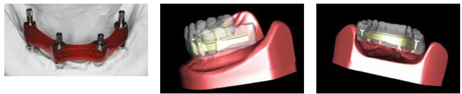 Figure 9: Verification index fabricated on the master cast using GC pattern resin. After intraoral try-in and evaluation, the index confirmed the correct interimplant orientation within the master cast. This step is essential to subsequent CAD/CAM manufacture of the framework; Figures 10A-10B: 10A. The master cast and the denture are both scanned in preparation for the design of the framework. This permits accurate orientation of the framework relative to tooth position as revealed in this rendering from the Cagenix AccuFrame® software. 10B. Cross-sectional representation reveals “Y” framework design visualized using Cagenix AccuFrame software