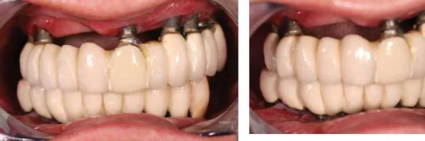 (L to r) Figure 2: Extensive loss of alveolar bone and soft tissue (3 years postoperative). Figure 3: Extensive hard and soft tissue loss on upper anterior and right side of the maxilla