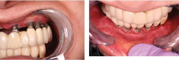 (L to r) Figure 4: Extensive hard and soft tissue loss on upper anterior and left side of the maxilla Figure 5: Lack of space in the vestibular sulcus due to fixtures positioned too far buccally. Note the lack of soft tissue available to cover the fixtures
