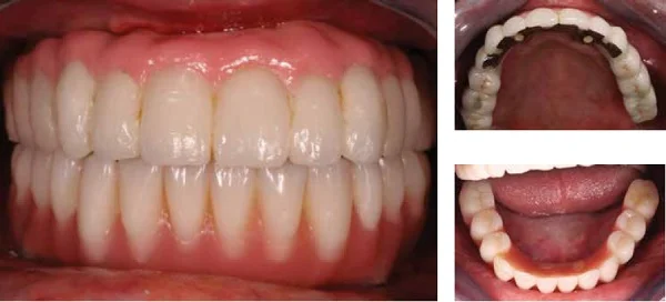 Left, Figure 21: Final upper porcelain fixed bridge restoration opposing the lower composite fixed bridge Upper right, Figure 22: Occlusal view of upper fixed PBM bridge. Lower right, Figure 23: Occlusal view of lower fixed bridge