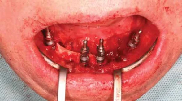 Figure 11: Taking impressions from the four NobelActive® implants inserted according to the All-on-4 principles