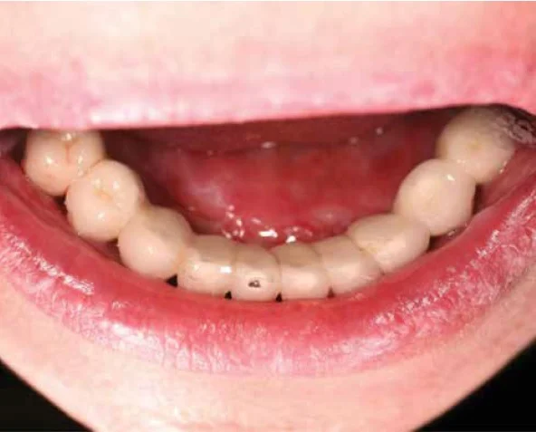 Figure 6: Sign of bruxism over the porcelain restorations