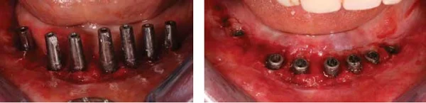 (L to r) Figure 7: Existing lower abutments after removal of the lower fixed bridge. Figure 8: Seven fixtures after removal of the abutments (system unknown to us)