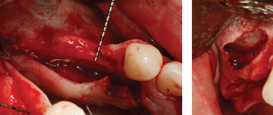 Figure 1: Occlusal view of the posterior maxilla showing the thin bone crest; Figure 2: View of the lateral window