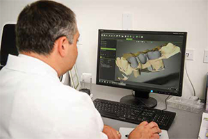 Designing a framework for a fixed partial denture using CAD/CAM technology