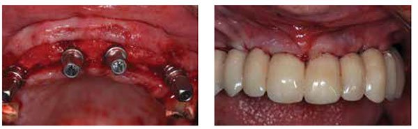 Figure 10: Intraoperative view showing the implants inserted into preselected positions decided upon using the cone beam CT scan; Figure 11: Transitional restoration made from data transferred from the diagnostic preview and the provisional metal acrylic frustration. The transitional restoration is supported by the abutments. It is used to develop soft tissue contours for a natural emergence profile
