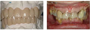 Figure 6: Diagnostic preview of proposed esthetic outcome and occlusal scheme; Figure 7: Preoperative view of malpositioned teeth and overclosed intermaxillary relationship