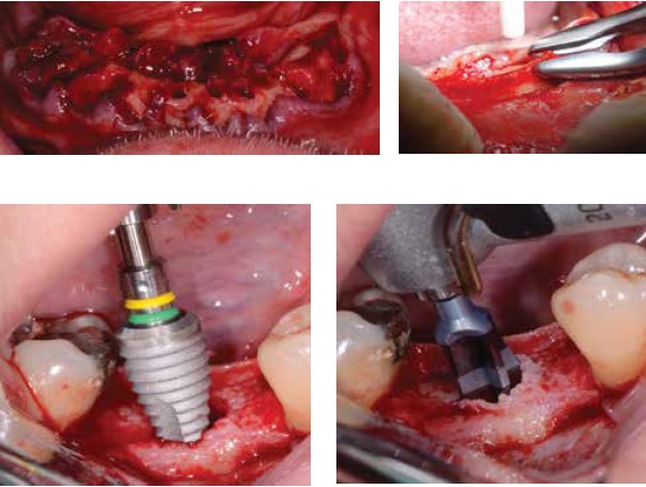 Upper Left: Figure 1: Extractions and ridge alveoloplasty for implant placement; Upper Right: Figure 2: Alveoloplasty of a knife ridge; Lower Left: Figure 3: Placement of a BioHorizons® Tapered Plus dental implant; Lower Right: Figure 4: Osteotomy for implant placement using the BioHorizons surgical drills.