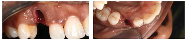 Figures 12 and 13: Following extraction of the UR3, the extent of the huge defect was evident