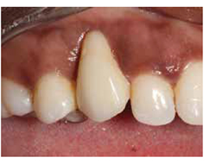 Figure 17: After 6 months of healing, a very long tooth was still present