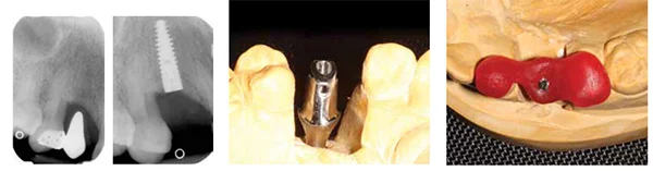 Figures 18A-18B: A. Preoperative radiograph. B. Radiograph showing implant placed 1 mm subcrestally; Figure 19: An abutment was selected and trimmed from the fixture head impression; Figure 20: Space was created palatally for a lateral screw