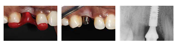 Figures 21-23: The palatal soft tissue was moved buccally at the time of implant exposure to reduce the soft tissue defect. The tissue is discolored as it has not been exposed to the mouth