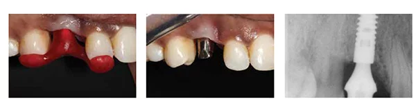 Figures 21-23: The palatal soft tissue was moved buccally at the time of implant exposure to reduce the soft tissue defect. The tissue is discolored as it has not been exposed to the mouth