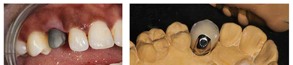 Figure 24: A metalwork pickup impression was taken and sent to the laboratory; Figure 25: The final crown was fabricated with palatal access for a lateral screw