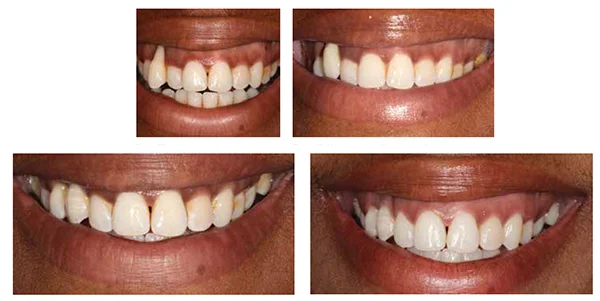 Figure 27: Initial presentation; Figure 28: After extraction with provisional bridge; Figure 29: Day of fit; Figure 30: Two-year review