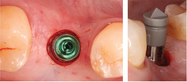 Figure 13: Flapless guided implant placement; Figure 14: Sirona ScanPost and Scanbody in place