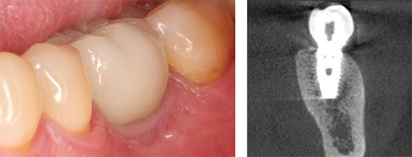 Figure 26: Buccal view of final restoration; Figure 27: Final postoperative CBCT scan