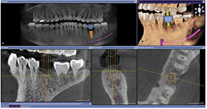 Figure 3: GALILEOS Implant CBCT implant treatment plan for site No. 19