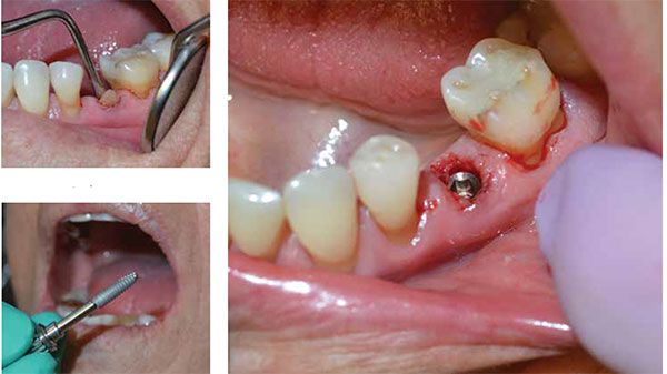 Figure 11: DBM allograft placement; Figure 12: ENGAGE implant; Figure 13: Final position of implant