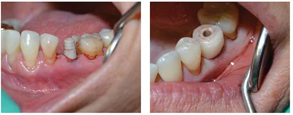 Figure 16: PEEK temporary abutment; Figure 17: Temporary before final finishing and access-hole sealing