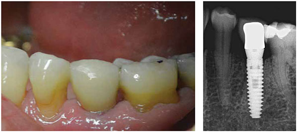 Figure 20: Delivery of final crown No. 20 at 6 weeks; Figure 21: Final radiograph