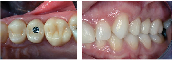 Figures 9 (left) and 10 (right): New digital impressions are not needed. Treatment was completed in two appointments. The customized healing abutment has the same shape but reduced occlusally to avoid immediate masticatory loads, and the definitive implant restoration is placed, achieving perfect adaptation over the soft tissue