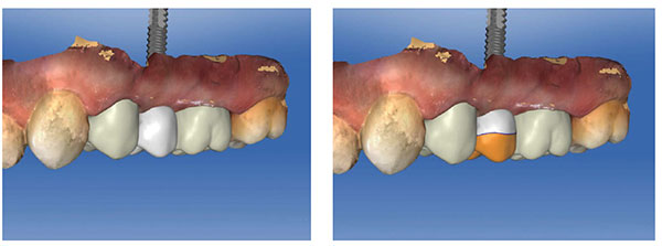 Figure 2: Digital design of final restoration immediately after implant placement; Figure 3: Shape reduction of implant restoration to create a customized healing abutment. The original shape is saved