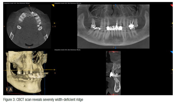 From “adamantly opposed” to “absolutely loved” on the anterior maxilla ...