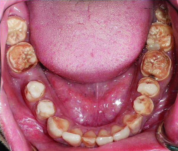 Implant CE Article - The era of monolithic translucent zirconia