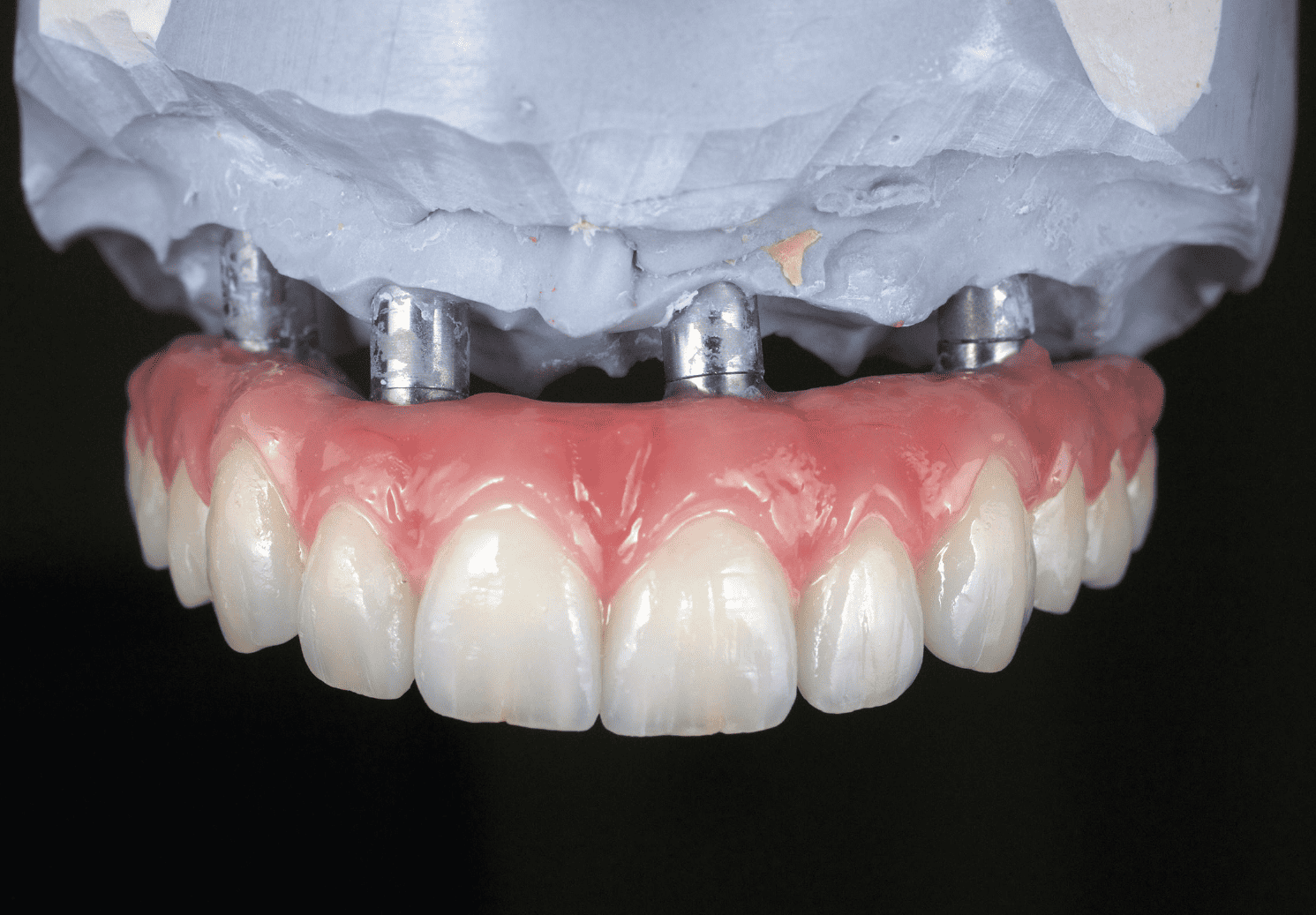 Implant CE Article Digital smile design in implant dentistry