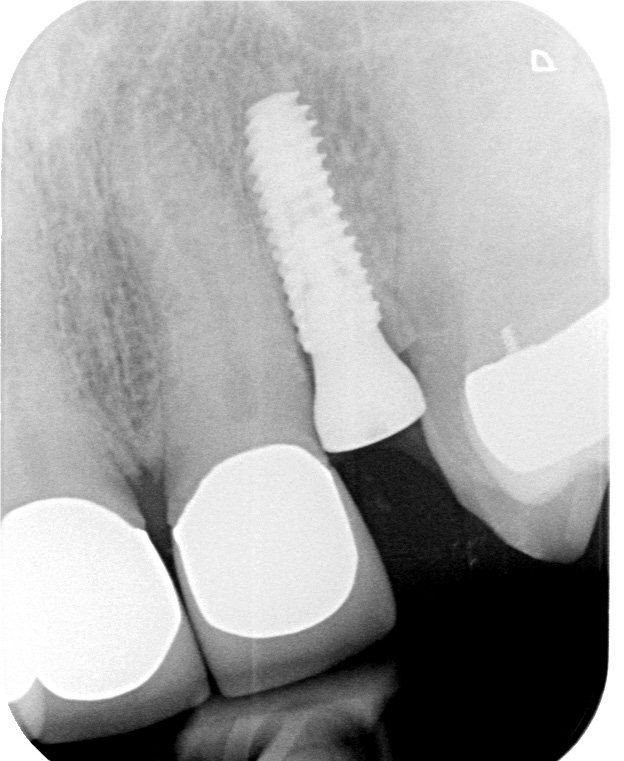The socket shield technique in implant treatment