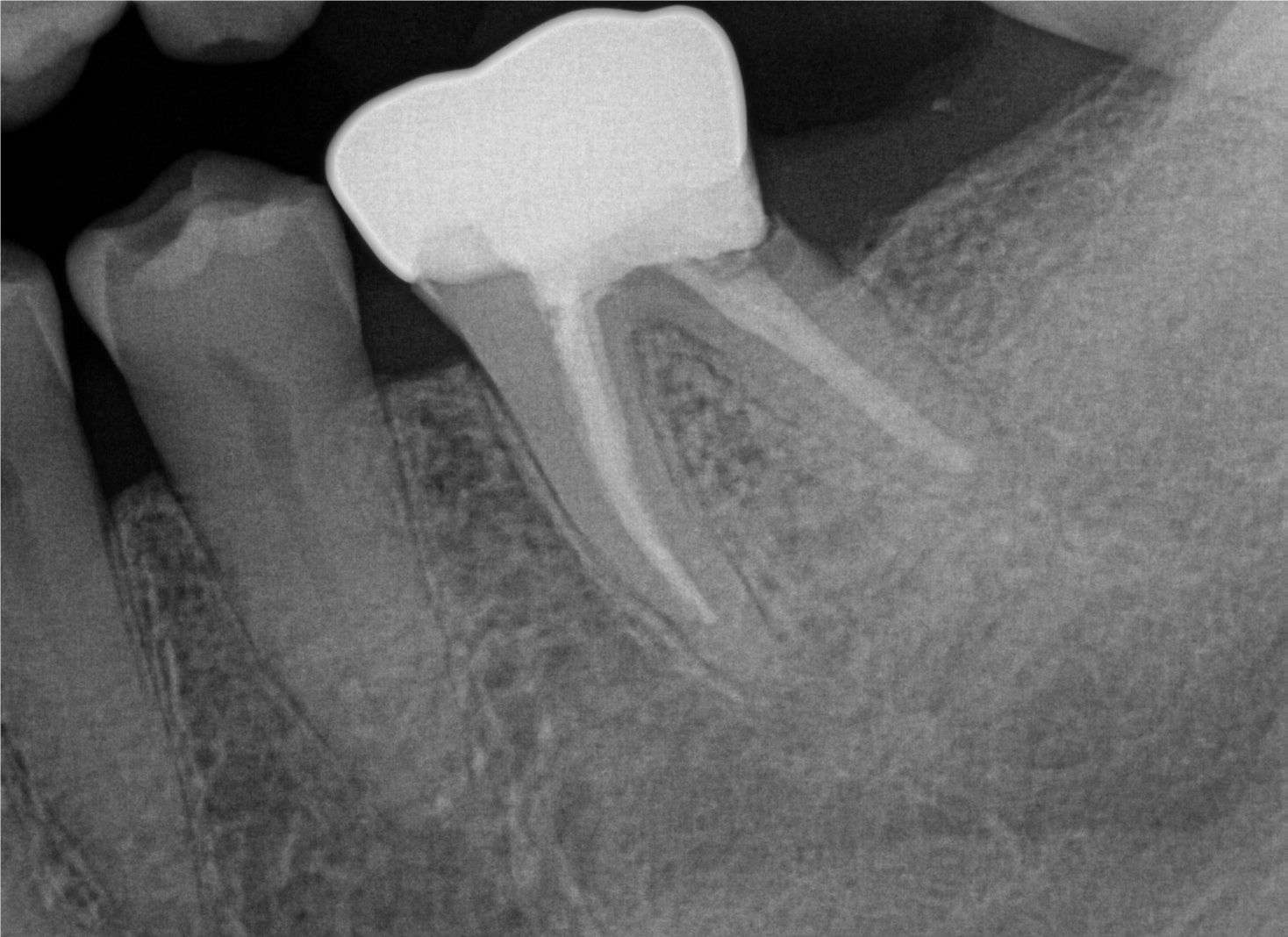 Precision is crucial in guided implant placement