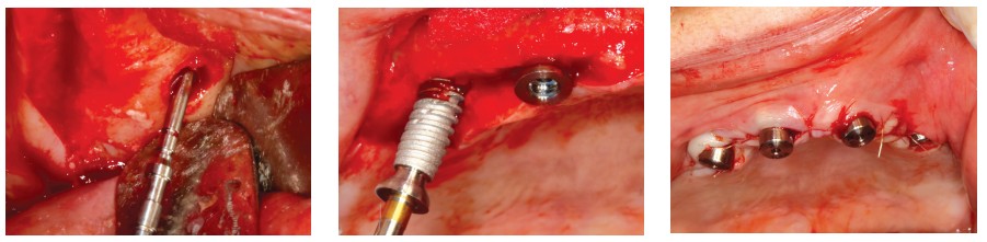 Figure 15 (left): The anterior sinus wall was marked; Figure 16 (center): Placement of the distal implant; Figure 17 (right): Sutures placed around the healing abutments